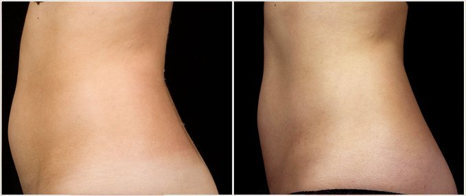 SculpSure Before and After Photos: female, left side view, patient 8