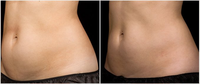 SculpSure Before and After Photos: female, left side oblique view, patient 9