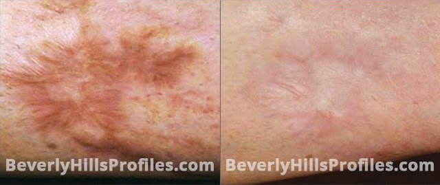 Acne Surgical Scars Before and After Photos - patient 4