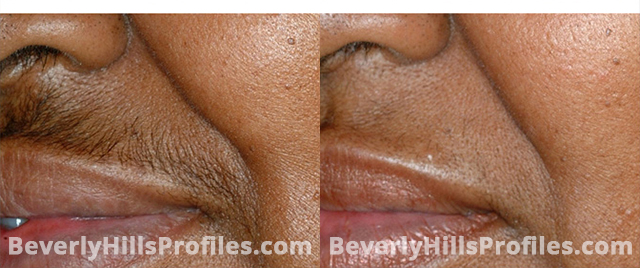 Unwanted Hair Before and After Photos: oblique view, male patient 3