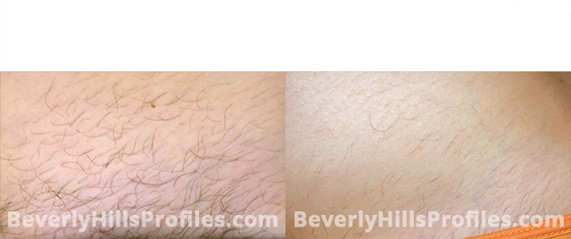 Unwanted Hair Before and After Photos: patient 4