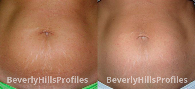 Stretch Marks Before and After Photos - female patient 1