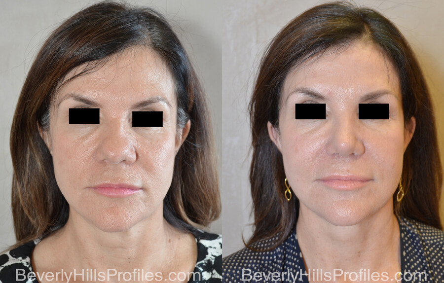 Facelift Before and After Photo Gallery - female, front view, patient 12