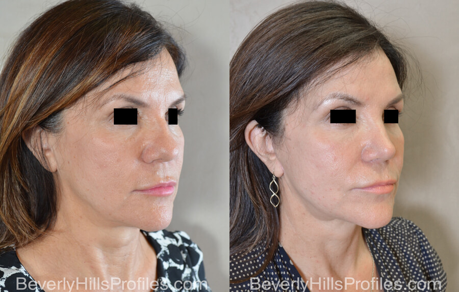 Facelift Before and After - female, right oblique view