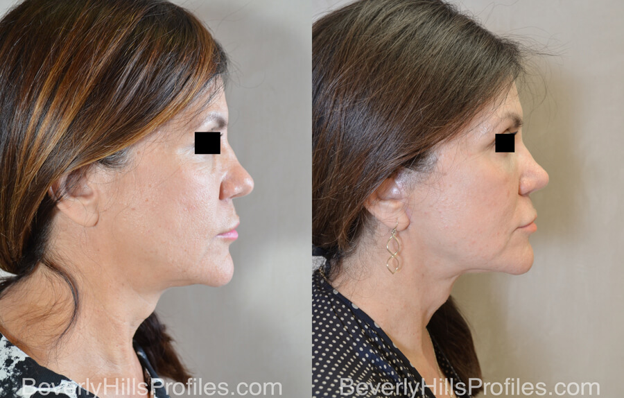 Facelift Before and After - female, side view