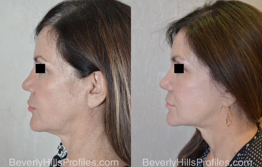 Facelift Before and After - female, right side view