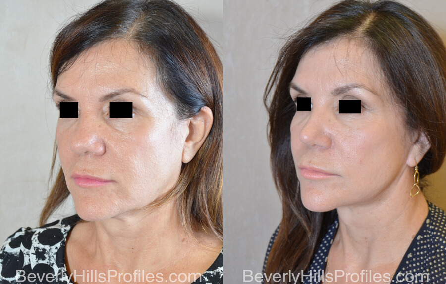 Facial Fat Transfer Before and After Photo Gallery - female, oblique view