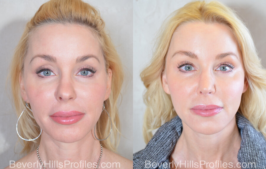 Facial Fat Transfer Before and After Photo Gallery - female, front view,patient 15