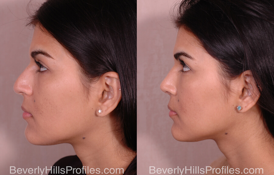 Facial Fat Transfer Before and After - female, side view
