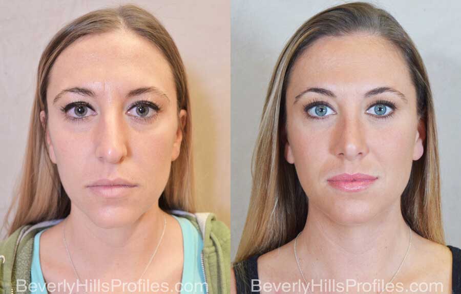 Rhinoplasty Before and After - female, front view