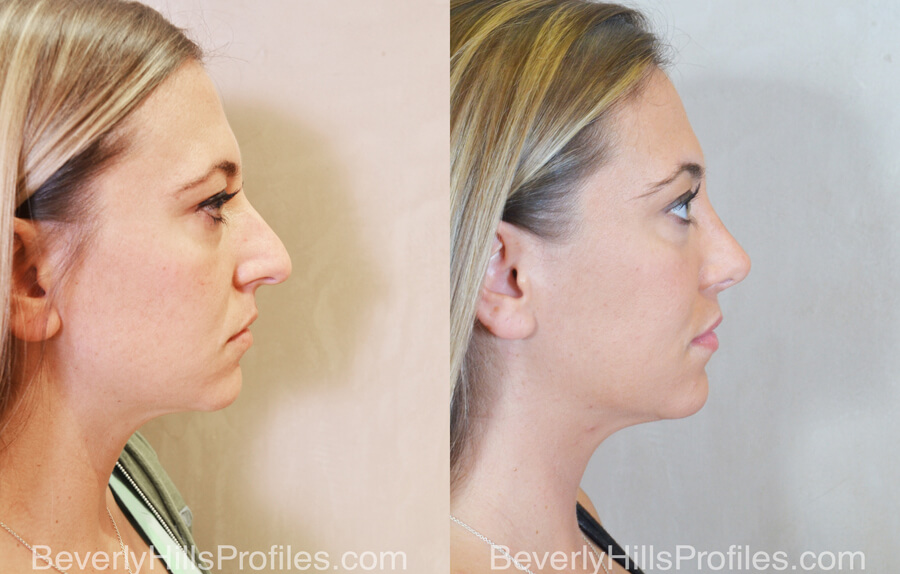 Rhinoplasty Before and After - female, right side view