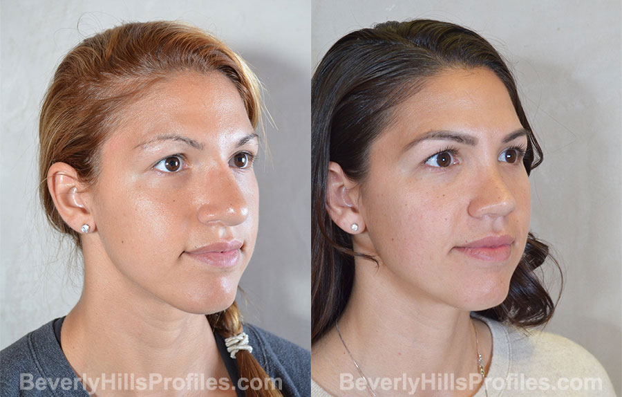 Revision Rhinoplasty Before and After Photo - female, right oblique view