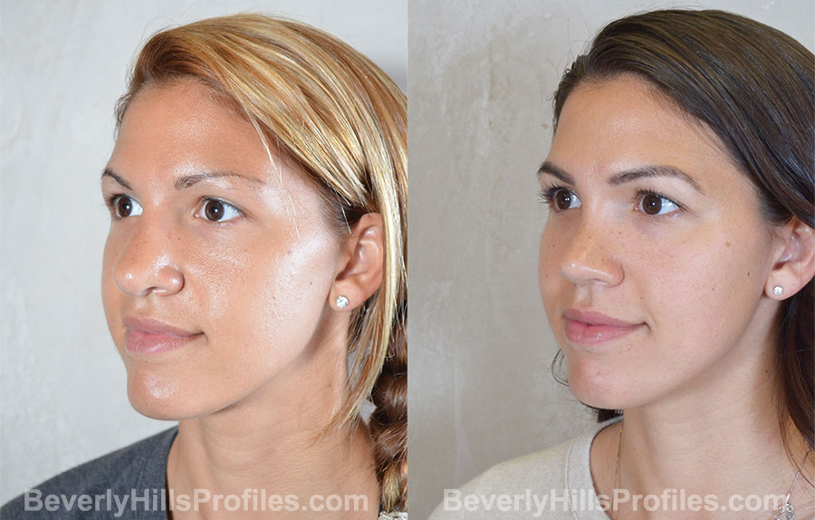 Revision Rhinoplasty Before and After Photo - female, oblique view