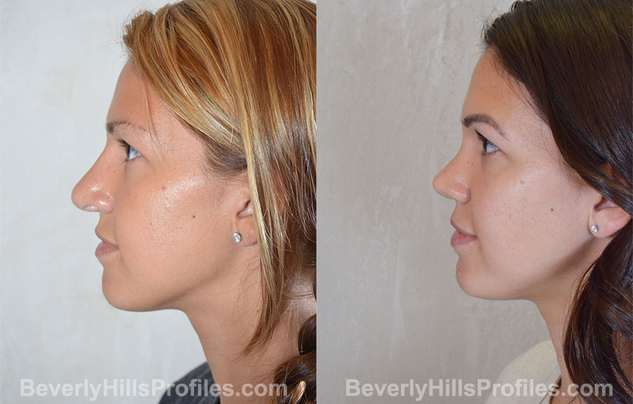 Revision Rhinoplasty Before and After Photo - female, side view