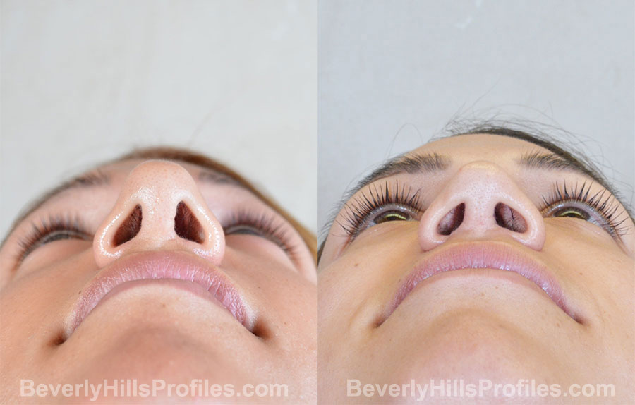 Revision Rhinoplasty Before and After Photo Gallery - female, bottom view