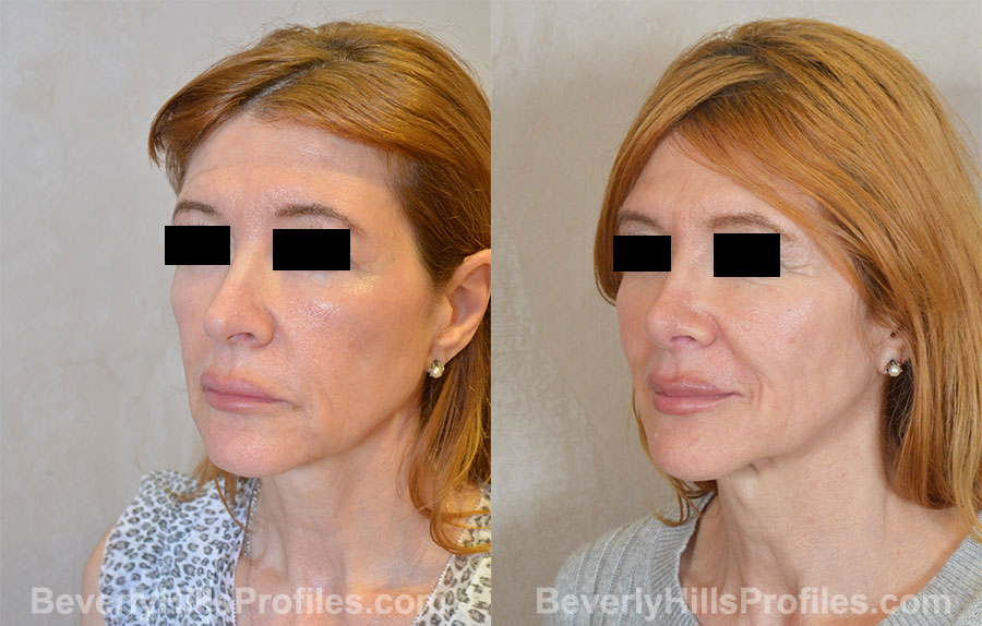 Rhinoplasty Before and After Photo Gallery - female, oblique view