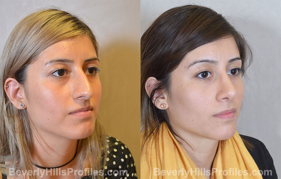 Rhinoplasty Before and After Photo Gallery - female, right oblique view