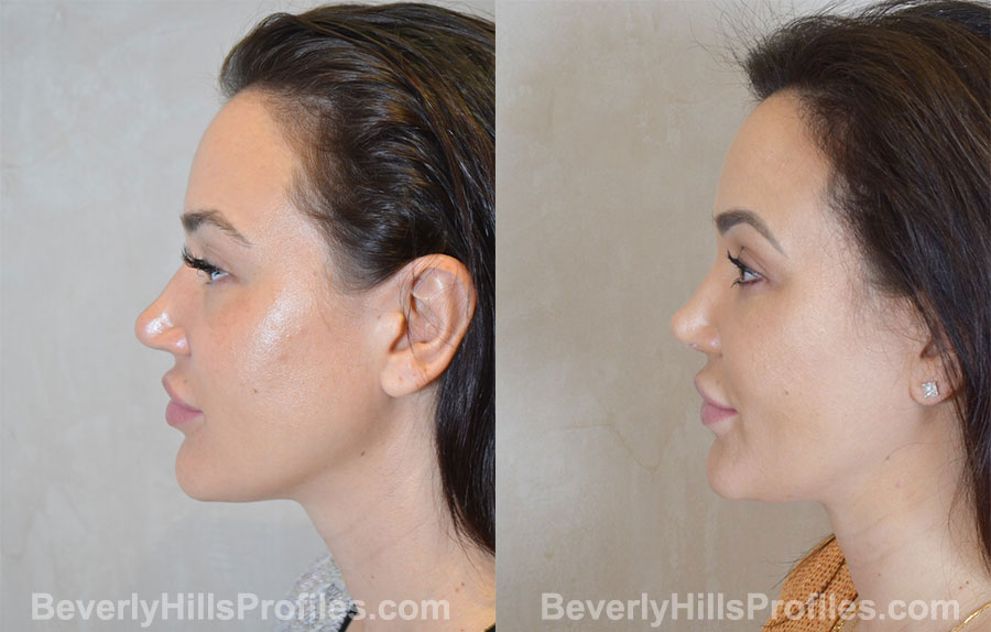 Rhinoplasty Before and After - female, side view
