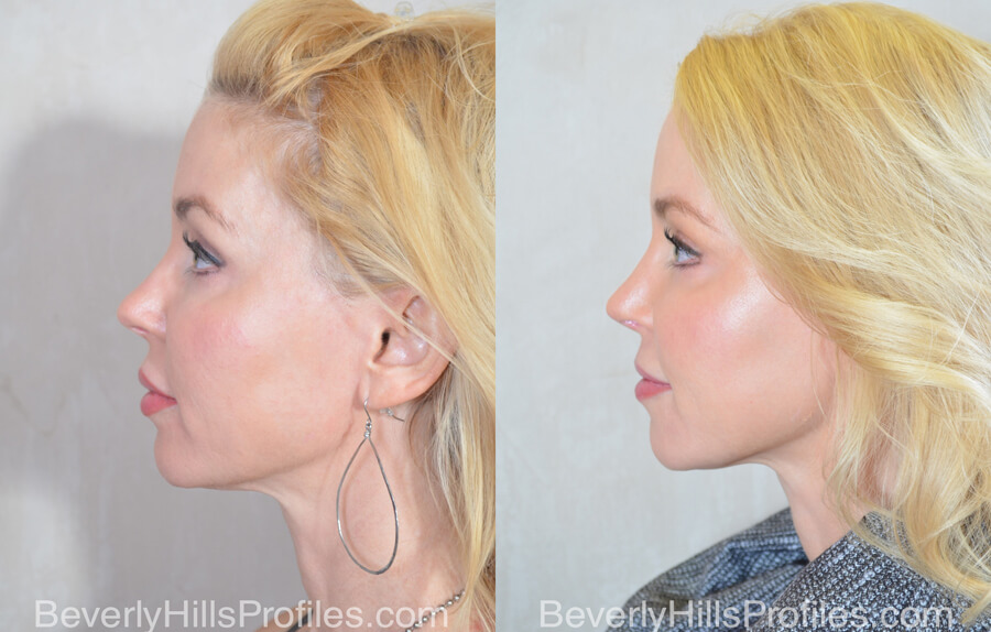Nose Job Before After - female, side view