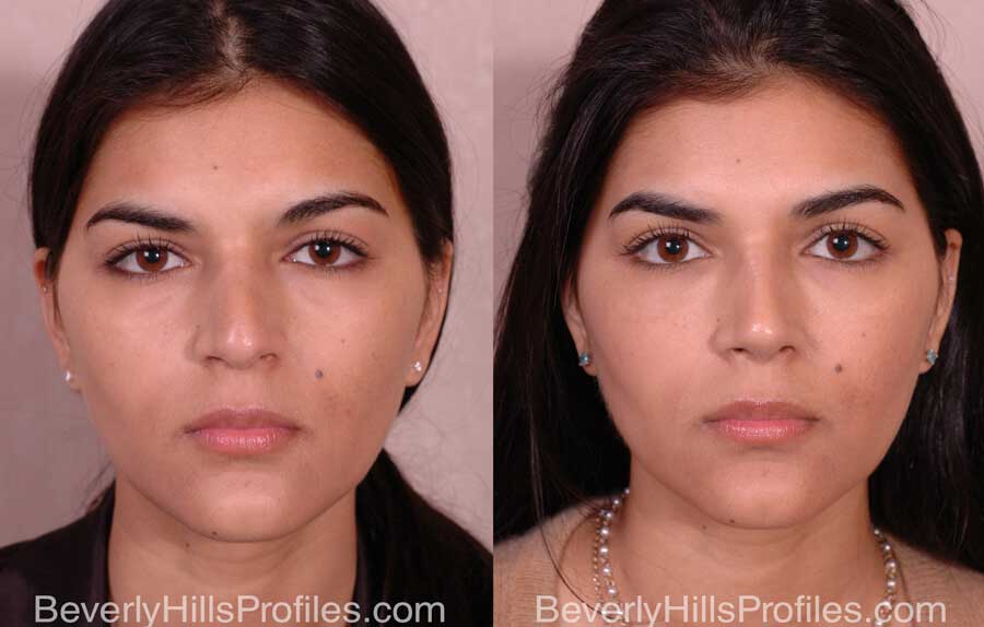 Nose Job Before and After - female, front view