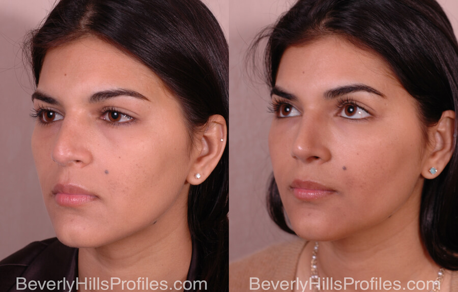 Nose Job Before and After - female, oblique view
