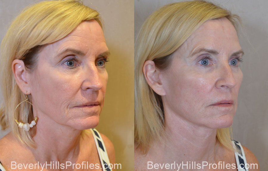 Facelift Before and After - old female, oblique view