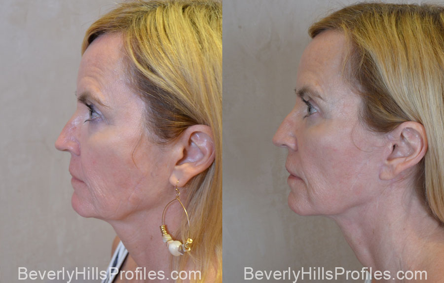 Facelift Before and After - old female, side view