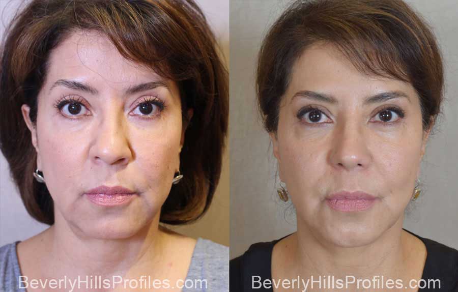 Facelift Before and After Photo Gallery - female, front view, patient 14