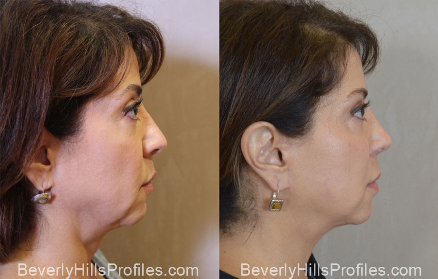 Facelift Before After - female, right side view