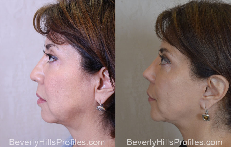 Facelift Before After - female, side view