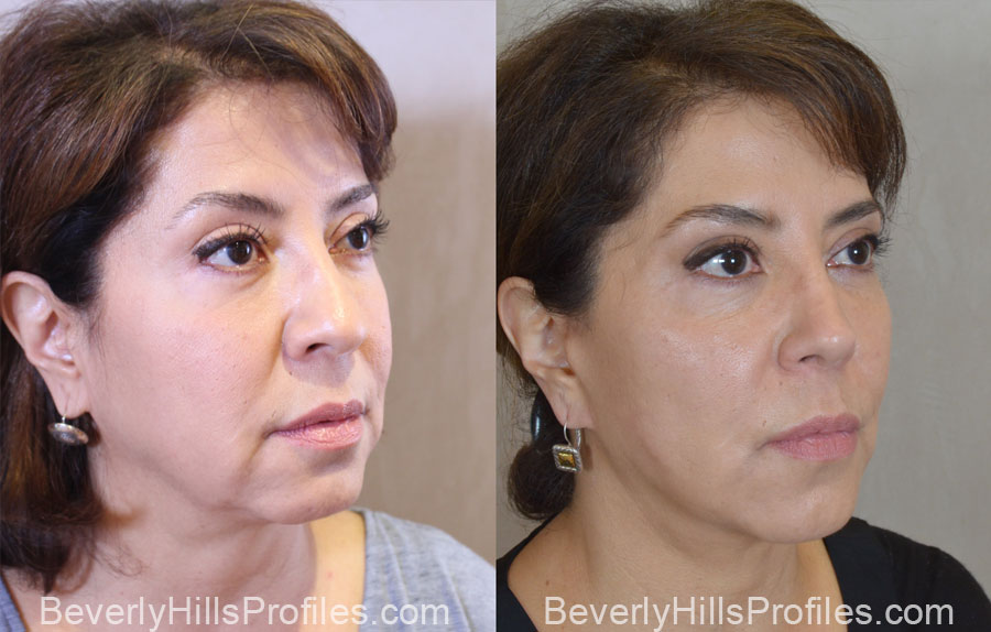 Facelift Before After - female, right oblique view