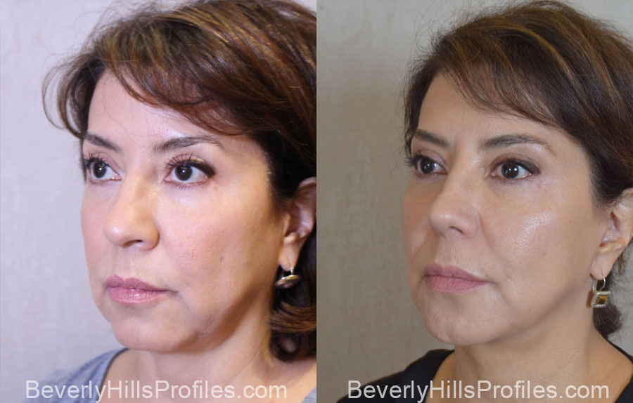 Facelift Before After - female, oblique view