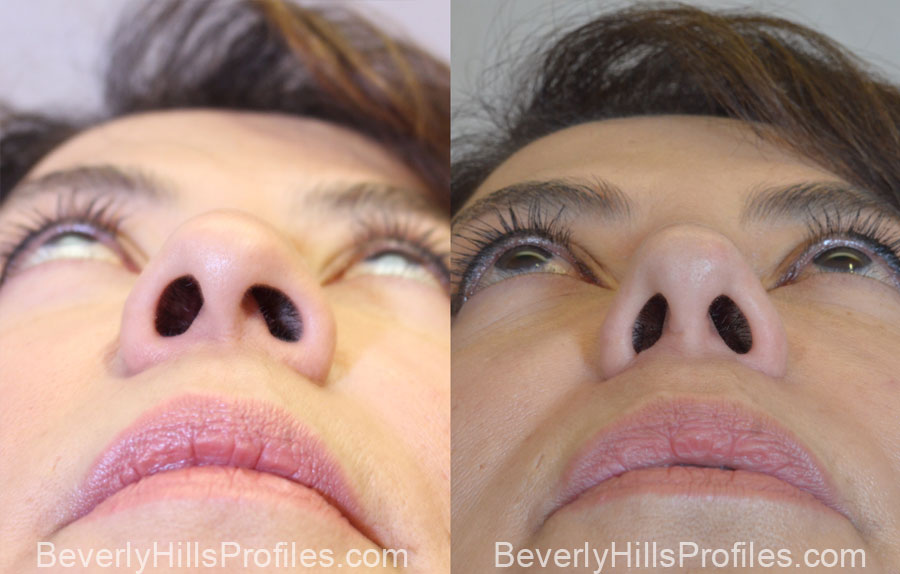 Facelift Before After - female, bottom view