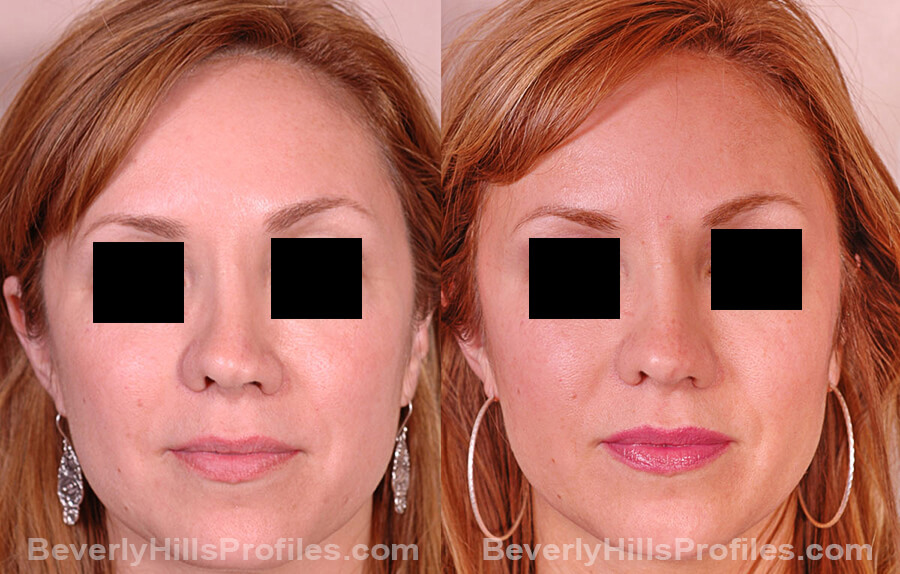 Revision Rhinoplasty Before and After Photo Gallery - female, front view