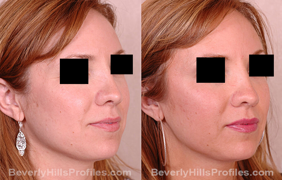 Revision Rhinoplasty Before and After Photo Gallery - female, oblique view