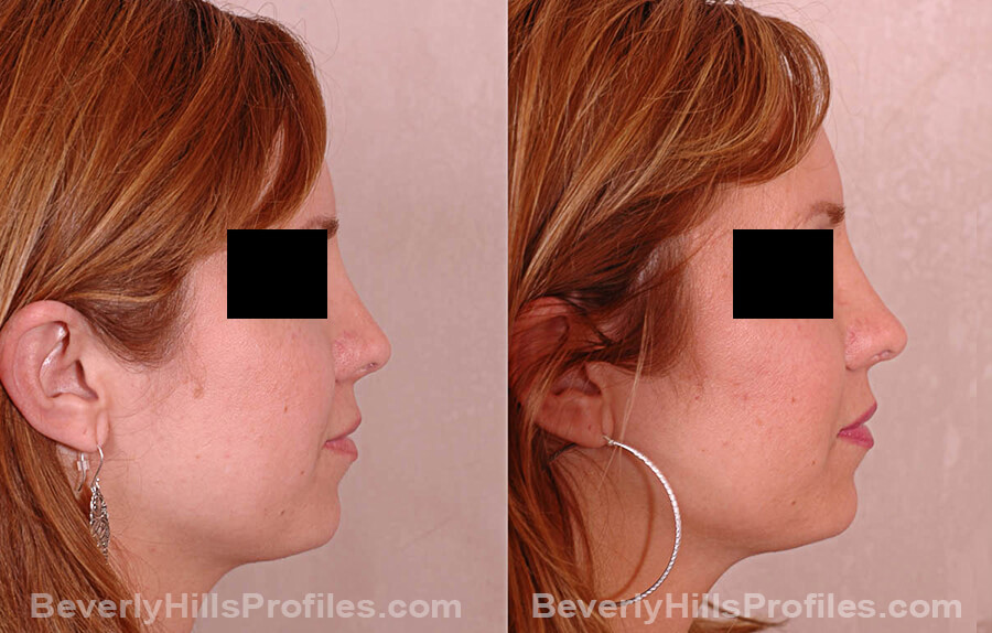 Revision Rhinoplasty Before and After Photo Gallery - female, side view