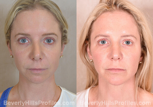 Female face, before and after Chin Implant treatment, front view, patient 12