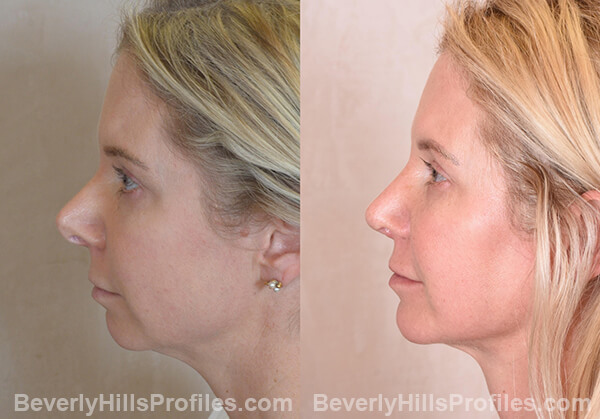 Chin Implants Before & After Photos - profile view