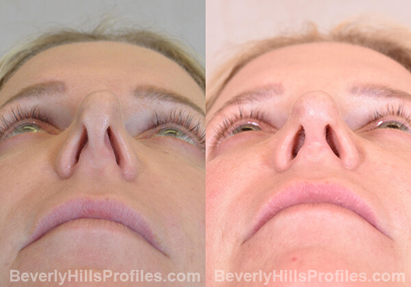 Chin Implants Before & After Photos - bottom view