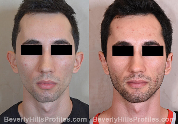 Otoplasty Before and After Photo Gallery - male, front view