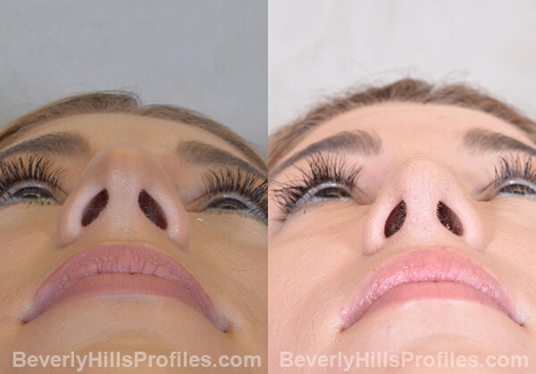 Nose Job Before and After Photo - female, bottom view