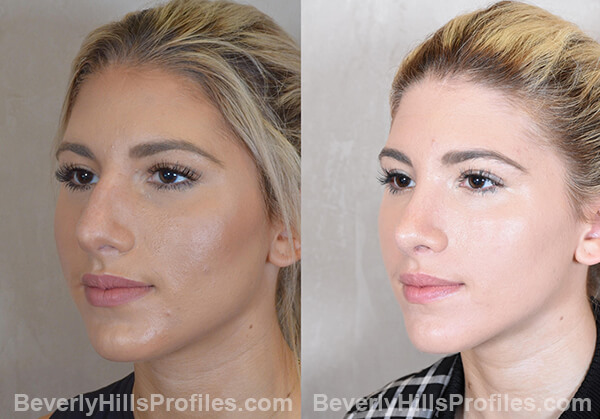 Nose Job Before and After Photo - female, right oblique view