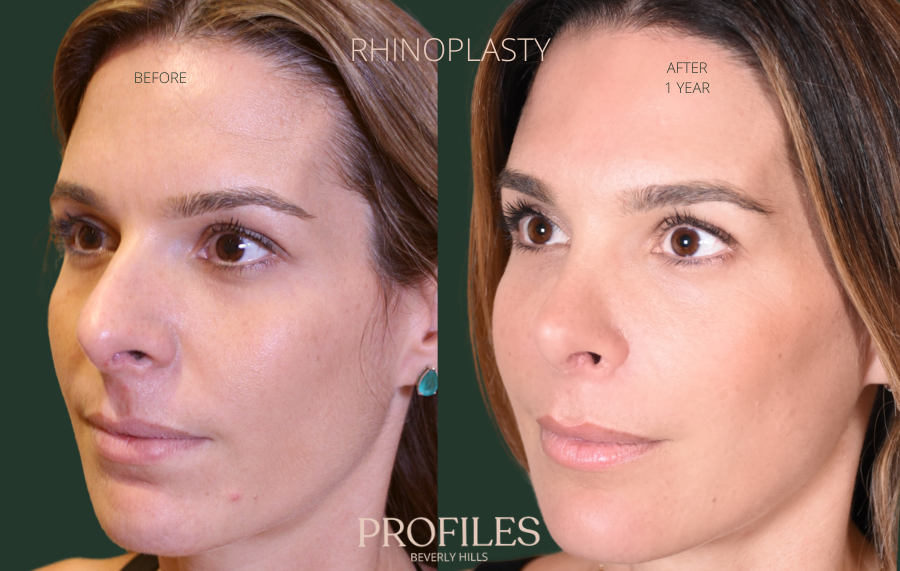 Woman's face, before and after Rhinoplasty treatment, r-side oblique view, patient 112