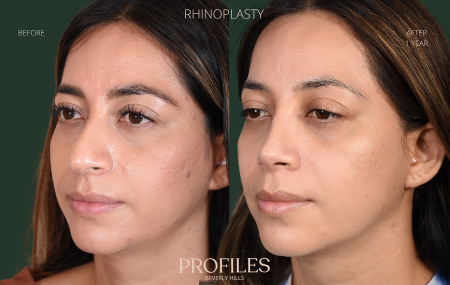 Woman's face, before and after Rhinoplasty treatment, l-side oblique view, patient 5