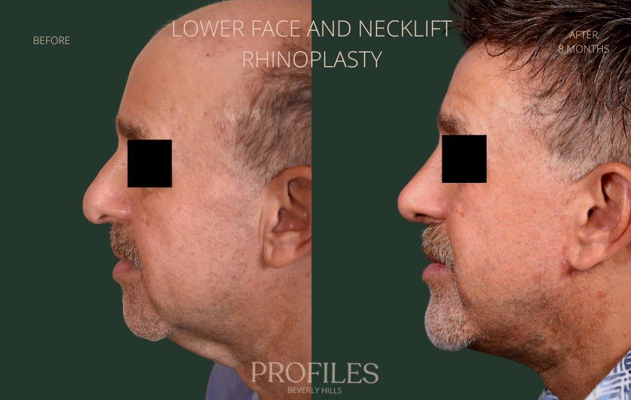 Male face, before and after Rhinoplasty treatment, l-side view, patient 2