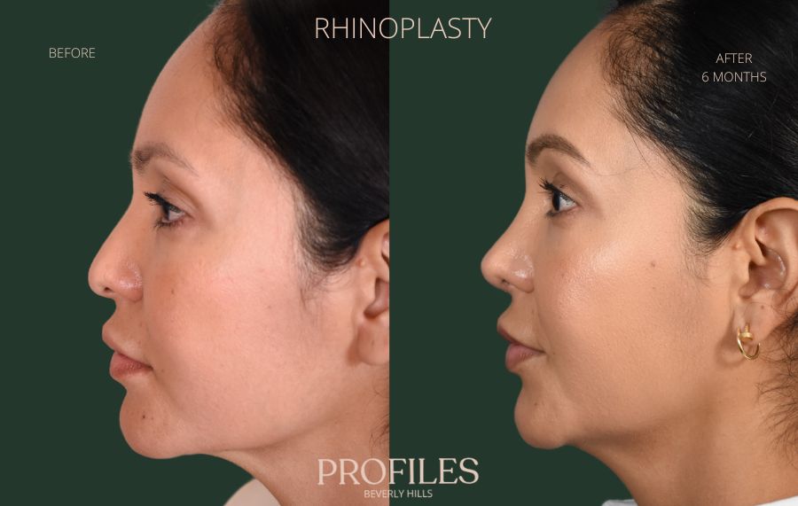 Woman's face, before and after Rhinoplasty treatment, l-side view, patient 6