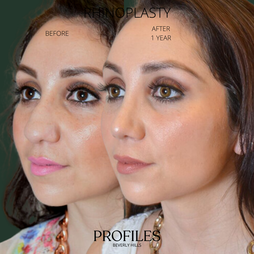 Woman’s face, before and after Ethnic Rhinoplasty treatment, l-side oblique view, patient 3