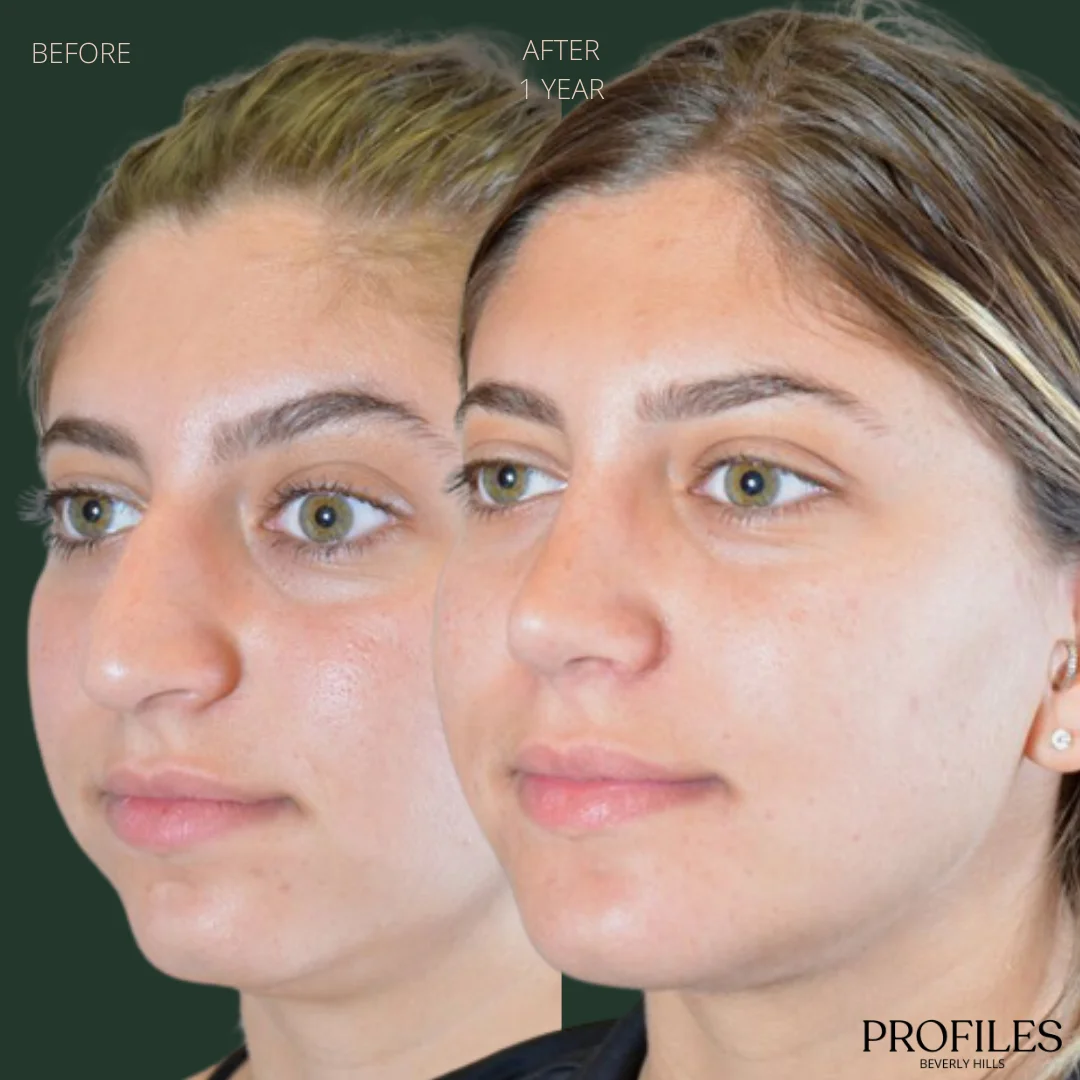 Woman’s face, before and 1 year after Rhinoplasty treatment, oblique view, patient 3
