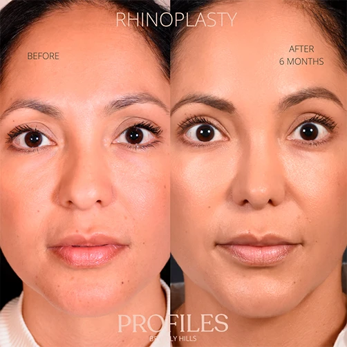 Woman’s face, before and 6 months after Rhinoplasty treatment, front view, patient 12