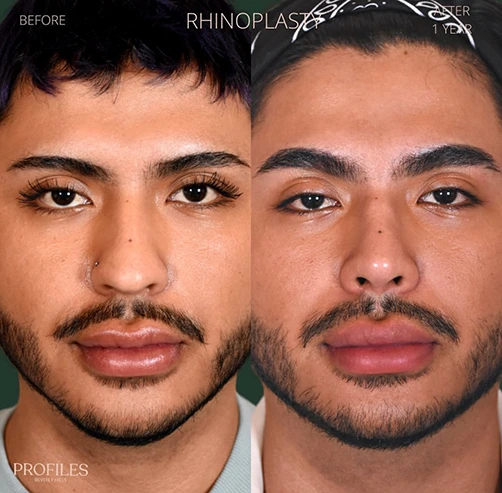 Male face, before and 1 year after Rhinoplasty treatment, front view, patient 10